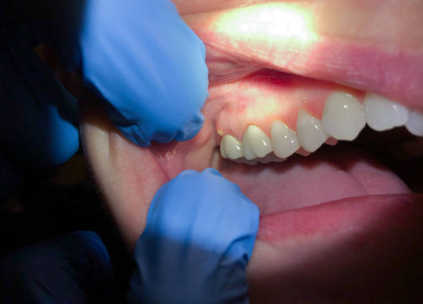 Best Tooth Infection Emergency Dentist  in Rocklin, CA